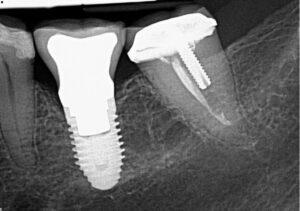 Рентген коронки зуба