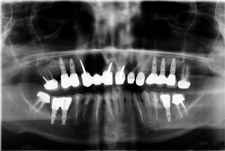 томографический снимок зубов с коронками