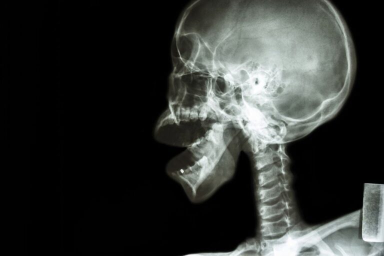 рентгенография височно-нижнечелюстного сустава